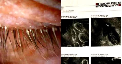  Eyelash Worm: Ein faszinierender Parasit mit einem Leben voller Wendungen!